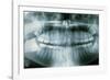 Panoramic Dental X-ray of Impacted Wisdom Teeth-Kaj Svensson-Framed Photographic Print