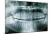 Panoramic Dental X-ray of Impacted Wisdom Teeth-Kaj Svensson-Mounted Photographic Print