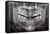 Panoramic Dental X-ray-null-Framed Stretched Canvas