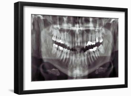 Panoramic Dental X-ray-null-Framed Photographic Print