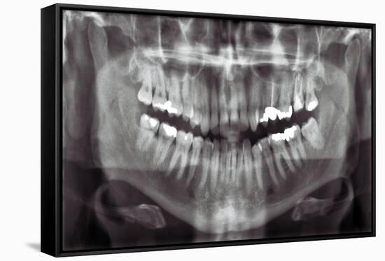 Panoramic Dental X-ray-null-Framed Stretched Canvas