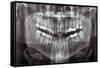 Panoramic Dental X-ray-null-Framed Stretched Canvas