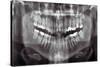 Panoramic Dental X-ray-null-Stretched Canvas