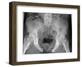 Pelvic Fracture, X-ray-Du Cane Medical-Framed Photographic Print