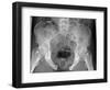 Pelvic Fracture, X-ray-Du Cane Medical-Framed Photographic Print