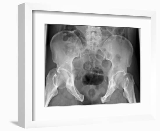 Pelvic Fracture, X-ray-Du Cane Medical-Framed Photographic Print