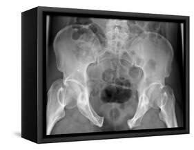 Pelvic Fracture, X-ray-Du Cane Medical-Framed Stretched Canvas