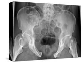 Pelvic Fracture, X-ray-Du Cane Medical-Stretched Canvas