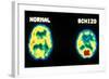 PET scans, normal and schizophrenic-Science Source-Framed Giclee Print