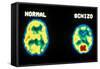 PET scans, normal and schizophrenic-Science Source-Framed Stretched Canvas