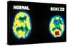 PET scans, normal and schizophrenic-Science Source-Stretched Canvas