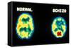 PET scans, normal and schizophrenic-Science Source-Framed Stretched Canvas