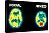 PET scans, normal and schizophrenic-Science Source-Stretched Canvas