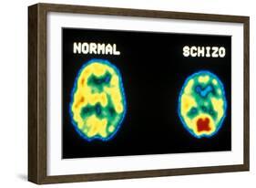 PET scans, normal and schizophrenic-Science Source-Framed Giclee Print