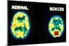 PET scans, normal and schizophrenic-Science Source-Mounted Giclee Print