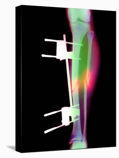 Pinned Broken Leg-Science Photo Library-Stretched Canvas