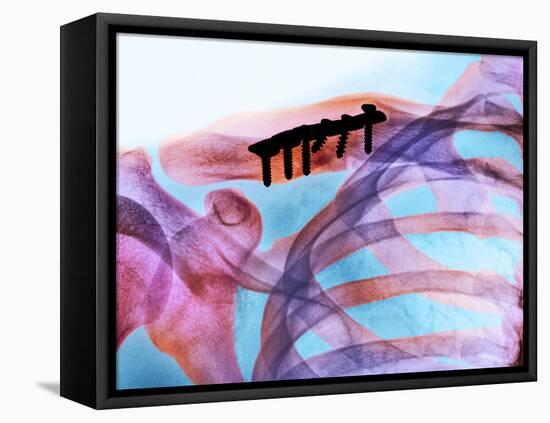 Pinned Collar Bone Fracture, X-ray-Science Photo Library-Framed Stretched Canvas