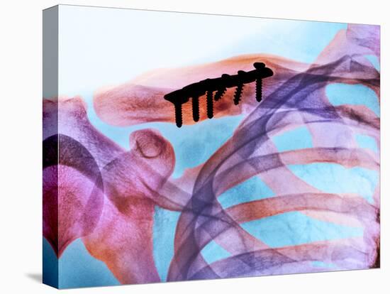 Pinned Collar Bone Fracture, X-ray-Science Photo Library-Stretched Canvas