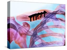 Pinned Collar Bone Fracture, X-ray-Science Photo Library-Stretched Canvas