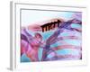 Pinned Collar Bone Fracture, X-ray-Science Photo Library-Framed Photographic Print