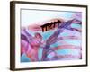 Pinned Collar Bone Fracture, X-ray-Science Photo Library-Framed Photographic Print