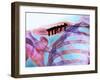 Pinned Collar Bone Fracture, X-ray-Science Photo Library-Framed Photographic Print