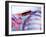 Pinned Collar Bone Fracture, X-ray-Science Photo Library-Framed Photographic Print