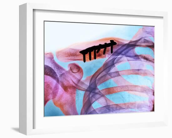 Pinned Collar Bone Fracture, X-ray-Science Photo Library-Framed Photographic Print