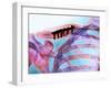 Pinned Collar Bone Fracture, X-ray-Science Photo Library-Framed Photographic Print