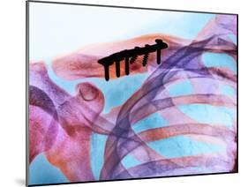 Pinned Collar Bone Fracture, X-ray-Science Photo Library-Mounted Photographic Print