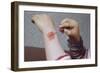 Placing Medicine on Infection-William P. Gottlieb-Framed Photographic Print