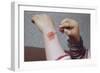 Placing Medicine on Infection-William P. Gottlieb-Framed Photographic Print