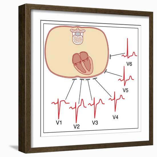 Placing of Electrodes for ECG, Artwork-Peter Gardiner-Framed Photographic Print