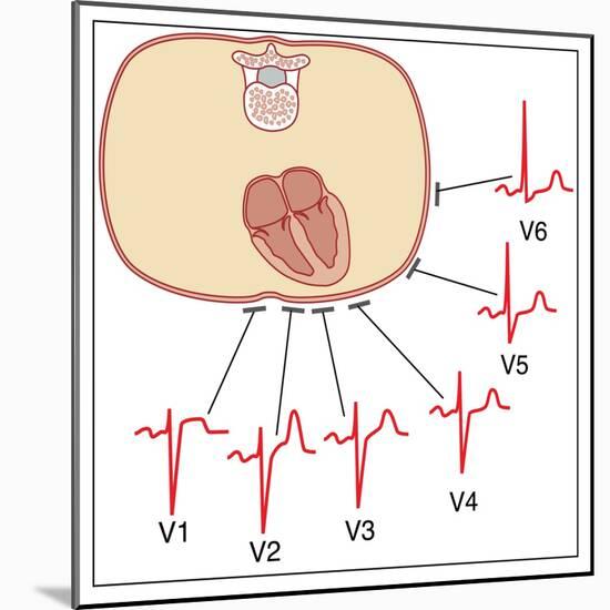 Placing of Electrodes for ECG, Artwork-Peter Gardiner-Mounted Photographic Print