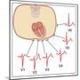 Placing of Electrodes for ECG, Artwork-Peter Gardiner-Mounted Photographic Print