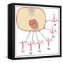 Placing of Electrodes for ECG, Artwork-Peter Gardiner-Framed Stretched Canvas