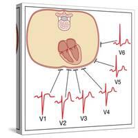 Placing of Electrodes for ECG, Artwork-Peter Gardiner-Stretched Canvas