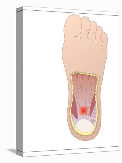 Plantar Fasciitis, Artwork-Peter Gardiner-Stretched Canvas