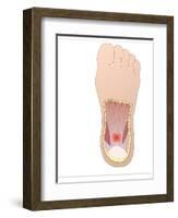 Plantar Fasciitis, Artwork-Peter Gardiner-Framed Photographic Print