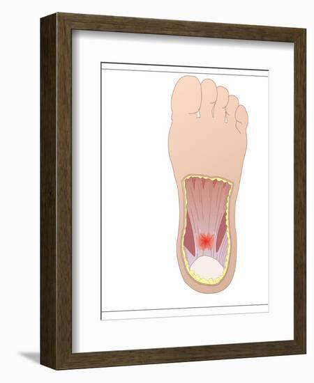 Plantar Fasciitis, Artwork-Peter Gardiner-Framed Photographic Print