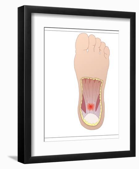 Plantar Fasciitis, Artwork-Peter Gardiner-Framed Photographic Print