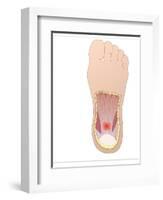 Plantar Fasciitis, Artwork-Peter Gardiner-Framed Photographic Print