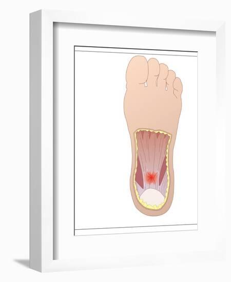 Plantar Fasciitis, Artwork-Peter Gardiner-Framed Photographic Print