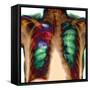 Pneumonia, X-ray-Du Cane Medical-Framed Stretched Canvas