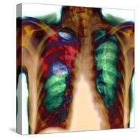 Pneumonia, X-ray-Du Cane Medical-Stretched Canvas