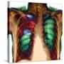 Pneumonia, X-ray-Du Cane Medical-Stretched Canvas