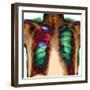 Pneumonia, X-ray-Du Cane Medical-Framed Premium Photographic Print