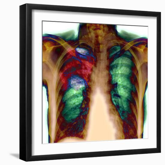 Pneumonia, X-ray-Du Cane Medical-Framed Premium Photographic Print