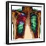 Pneumonia, X-ray-Du Cane Medical-Framed Premium Photographic Print