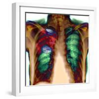 Pneumonia, X-ray-Du Cane Medical-Framed Premium Photographic Print